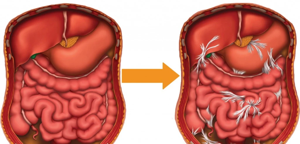Adhesions-before-after-1024x493-1 Adhesions-before-after-1024x493-1